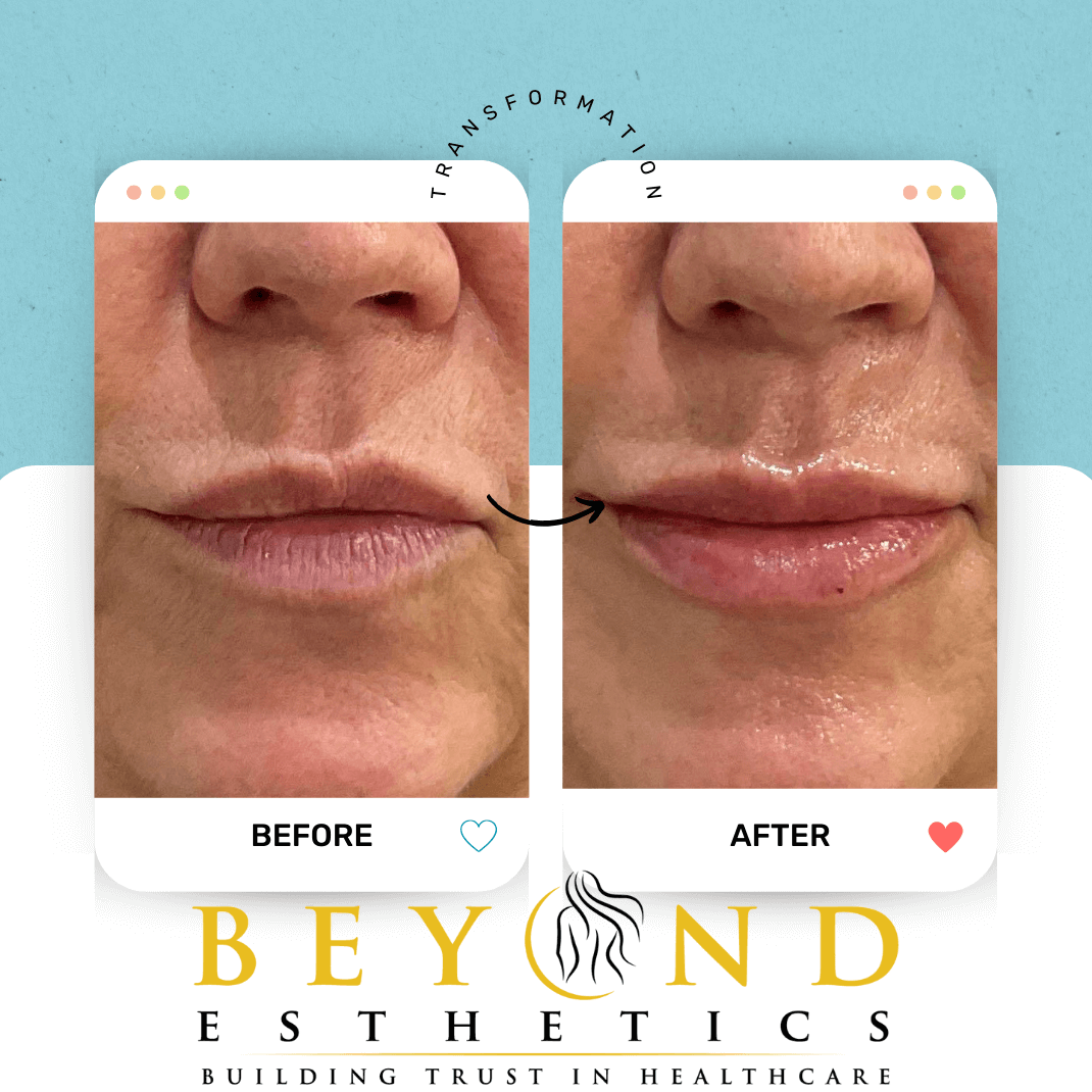 Lips - facial rebalancing